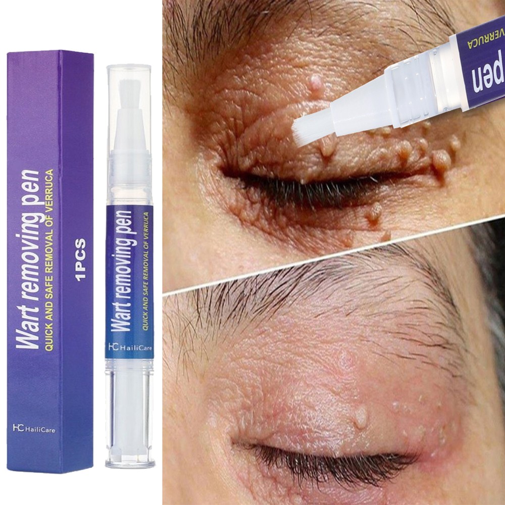 1 PACK Skin Tag Remover Pen Skin Tag Mole Wart Dark Spot Remover Painless & Safe