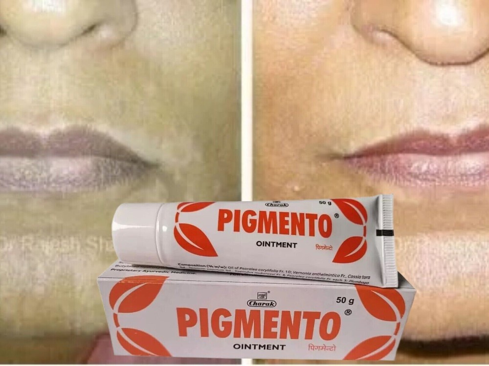 Charak Pigmento Ointment (50gm) for Vitiligo, Pigmentation 100% Herbal