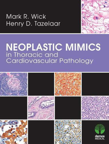Neoplastic Mimics in Thoracic and Cardiovascular Pathology (Pathology of Neoplas
